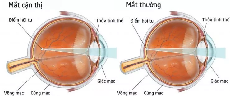 alt text: Hình ảnh mô tả mắt cận thị và mắt bình thường